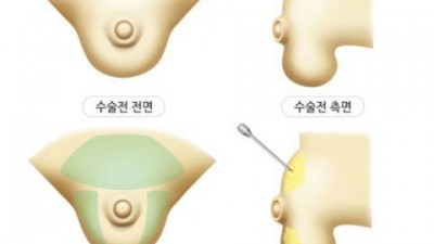 남자친구가 자라 고추라서 슬픈 여자친구